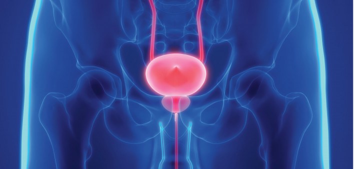 Cancer de prostata diagnostico y tratamiento, Cancer de prostata diagnostico diferencial.